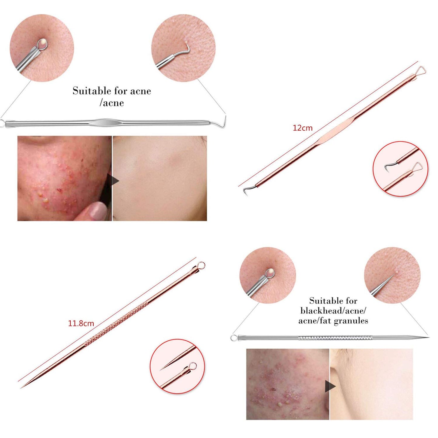 4-Piece Rose Gold Blackhead & Pimple Extractor Tool Set with Case – Acne & Comedone Removal Kit